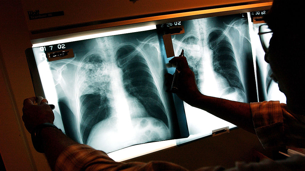 2 active tuberculosis cases traced to San Francisco strip club — KTVU FOX 2 Bay Area, Larkspur Health news